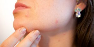 best-acne-treatment